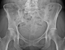 Seniors with type 2 diabetes have higher fracture risk